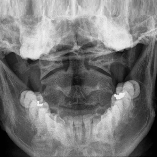 X-Ray Cervical Spine Open Mouth View Test